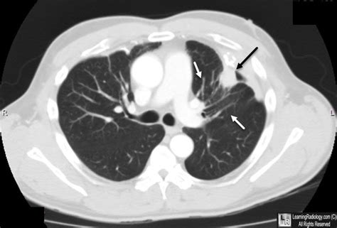 rotonda sign|Round atelectasis .